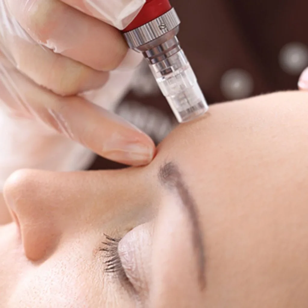 Nano Needling Cicero IL