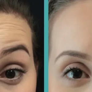 Botox Before And After Treatment of forehead lines
