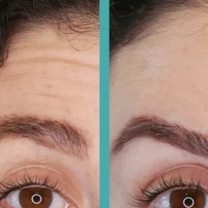 Wrinkles reduced before and after treatment of Botox