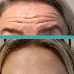 dramatic botox injections on forehead before and after