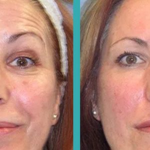 where-can-you-get-the-best-botox-chicago-treatment