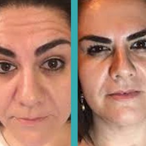 botox wrinkle reduction on female patients in Chicago