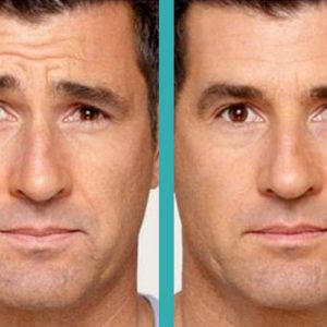 botox treatment on Forehead of a Man