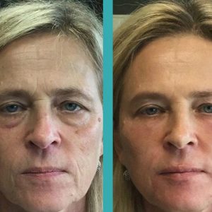 Botox Injections on Forehead and under eyes